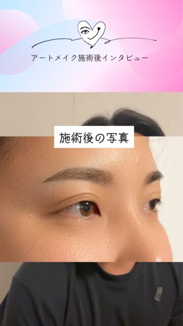 眉アートメイク𝐁-𝐁𝐑𝐎𝑾
モニター様(男性2回目)の施術後のインタビュー動画です♪
動画でも内容を聞けますが、こちらでもお読みいただけます↓
モニターを受けていただき、どうもありがとうございました!
Q.施術した後、鏡を見てどうですか?
A.めっちゃ綺麗です!
すごい綺麗に入ってます。
Q.もともとどんな悩みがあったんですか?
A.もともと整えるけど上下違うとか、左右長さが違うみたいなことがあったんですけど、すごい綺麗に入れてもらえて、目元もクッキリしていいですね。
Q.スッキリしましたよね。あと痩せて見えますね。
A.はい、言われますね。
1回目の施術の後、言われました。
Q.すごくシャープになって、格好良くなったと思います。
A.ありがとうございます!
Q.明日からの楽しみはありますか?
A.人に会うのが楽しみです!
Q.きっと皆さん気づいてくれます。
A.嬉しいです!ありがとうございます!
2回にわたるアートメイクの施術、ありがとうございました!
𝐀𝒓𝒕𝐦𝐚𝐤𝐞ꕤ︎︎𝐀𝐤𝐢𝐜𝐨
まもなく3/31までの限定モニター価格のご予約を終了いたします
4/1からは料金改定がございますので、モニターを受けてくださる方はDM・LINE・hpからご連絡ください♪
よろしくお願いいたします
🫧モニター募集のお知らせ🫧
アートメイクモニター募集のお知らせ
格安料金でアートメイクをしてみませんか?
10名様限定で3月末までモニター特別割引価格で実施してまいりましたが、皆様のご協力と温かいご支援につき、3月はご予約いっぱいとなりました🙇♀️
心より深く感謝申し上げます✨
【4月ご予約受付中】
今月末までのご予約確定で
“3月末までの価格”でご案内可能です✨
🔴残りわずか若干名です
ご希望の方はDM又はLINE・hpからご連絡ください📩
施術日に関しては、4月5日以降のご予約・ご案内になります
4月以降はオープニングキャンペーンでのご案内と共に、料金改定がございます。また日を改めてご案内させていただきますので、引き続きどうぞ宜しくお願いいたします♪
また、エリア拡大の準備中です。新宿・横浜の提携クリニックさんでの施術が可能になります。準備整い次第、発表致しますので、よろしくお願いします。
また、武蔵野市・吉祥寺・三鷹市エリアで提携してくださるクリニックさんも探しております。
もし目に留まったクリニックの医師・開業医の諸先生方がいらっしゃいましたら、ご挨拶にお伺いさせていただきたいと思います!小さなことからでも情報を知ってらっしゃる方がおりましたら、重ねてご連絡ください。
よろしくお願いいたします🙇♂️
------------------------
今なら眉毛(2回)が
110,000円→55,000円
と通常価格より55,000円
もお🉐になっています。
実施場所は、東京都内(戸越銀座)となります。
✅️アートメイクに興味ある方
✅️B−BROWでアートメイクをしてみたい方
は、より詳しい内容(料金や体験者さまの感想など)をプロフのURLから詳細をチェックしてください。
ぜひぜひお待ちしてます!
𝐀𝒓𝒕𝐦𝐚𝐤𝐞ꕤ︎︎𝐀𝐤𝐢𝐜𝐨
#男性のアートメイク
#アートメイクモニター募集
#アートメイク
#アートメイク吉祥寺
#アートメイク三鷹
#アートメイク武蔵野市
#眉アートメイク
#bbrow
#眉毛コンプレックス
#眉毛が薄い
#眉毛に悩んでいる
#眉なし
#眉毛薄い
#すっぴん眉
#左右非対称
#眉毛が生えない
#アトピー眉毛
#すっぴんに自信がない
#時短メイク
#メイク時短