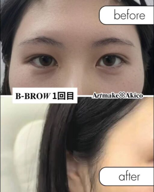 眉アートメイク𝐁-𝐁𝐑𝐎𝑾
モニター様施術事例のご紹介ですꕤ︎︎·͜·
今回は女性(1回目)のモニター様のビフォー・アフター写真です♪
元々めちゃくちゃ可愛い🩷
背も高いくモデルさんのようなモニター様✨
今後のお仕事が更に発展していくようにと
モニターを受けてくださいました♪
前もってニードルで脱毛されてから
施術を迎えてくださったので、ムダ毛がなく
𝐁-𝐁𝐑𝐎𝑾で綺麗にアートメイクさせていただきました
アートメイクでもっと可愛くお顔がキリッと
より美人になりました💞
これからのお仕事、頑張られてくださいね✨
モニター様
大切なお顔をお任せくださりありがとうございました!2回目の定着楽しみです!
そして、ご希望通りに仕上げらるように
全力でご指導してくださったアシスタントの皆様にも心から感謝です
1回目は土台作り✨
2回目で完成✨
𝐁-𝐁𝐑𝐎𝑾は直後から自然な仕上がりに
なります♪
4/1からは料金改定がございますので、ハイライトでのオープニングモニター価格ご参照ください
モニターを受けてくださる方はDM・LINE・hpからご連絡ください♪
よろしくお願いいたします
𝐀𝒓𝒕𝐦𝐚𝐤𝐞ꕤ︎︎𝐀𝐤𝐢𝐜𝐨
🫧モニター募集のお知らせ🫧
アートメイクモニター募集のお知らせ
格安料金でアートメイクをしてみませんか?
10名様限定で3月末までモニター特別割引価格で実施してまいりましたが、皆様のご協力と温かいご支援につき、3月はご予約いっぱいとなりました🙇♀️
心より深く感謝申し上げます✨
【4月ご予約受付中】
今月末までのご予約確定で⚠️
“3月末までの価格”でご案内可能です✨
🔴残りわずか若干名です
ご希望の方はDM又はLINE・hpからご連絡ください📩
施術日に関しては、4月5日以降のご予約・ご案内になります
4月以降はオープニングキャンペーンでのご案内と共に、料金改定がございます。また日を改めてご案内させていただきますので、引き続きどうぞ宜しくお願いいたします♪
また、エリア拡大の準備中です。新宿・横浜の提携クリニックさんでの施術が可能になります。準備整い次第、発表致しますので、よろしくお願いします。
また、武蔵野市・吉祥寺・三鷹市エリアで提携してくださるクリニックさんも探しております。
もし目に留まったクリニックの医師・開業医の諸先生方がいらっしゃいましたら、ご挨拶にお伺いさせていただきたいと思います!小さなことからでも情報を知ってらっしゃる方がおりましたら、重ねてご連絡ください。
よろしくお願いいたします🙇♂️
------------------------
今なら眉毛(2回)が
110,000円→55,000円
と通常価格より55,000円
もお🉐になっています。
実施場所は、東京都内(戸越銀座)となります。
✅️アートメイクに興味ある方
✅️B−BROWでアートメイクをしてみたい方
は、より詳しい内容(料金や体験者さまの感想など)をプロフのURLから詳細をチェックしてください。
ぜひぜひお待ちしてます!
𝐀𝒓𝒕𝐦𝐚𝐤𝐞ꕤ︎︎𝐀𝐤𝐢𝐜𝐨
#男性のアートメイク
#アートメイクモニター募集
#アートメイク
#アートメイク吉祥寺
#アートメイク三鷹
#アートメイク武蔵野市
#眉アートメイク
#bbrow
#眉毛コンプレックス
#眉毛が薄い
#眉毛に悩んでいる
#眉なし
#眉毛薄い
#すっぴん眉
#左右非対称
#眉毛が生えない
#アトピー眉毛
#すっぴんに自信がない
#時短メイク
#メイク時短