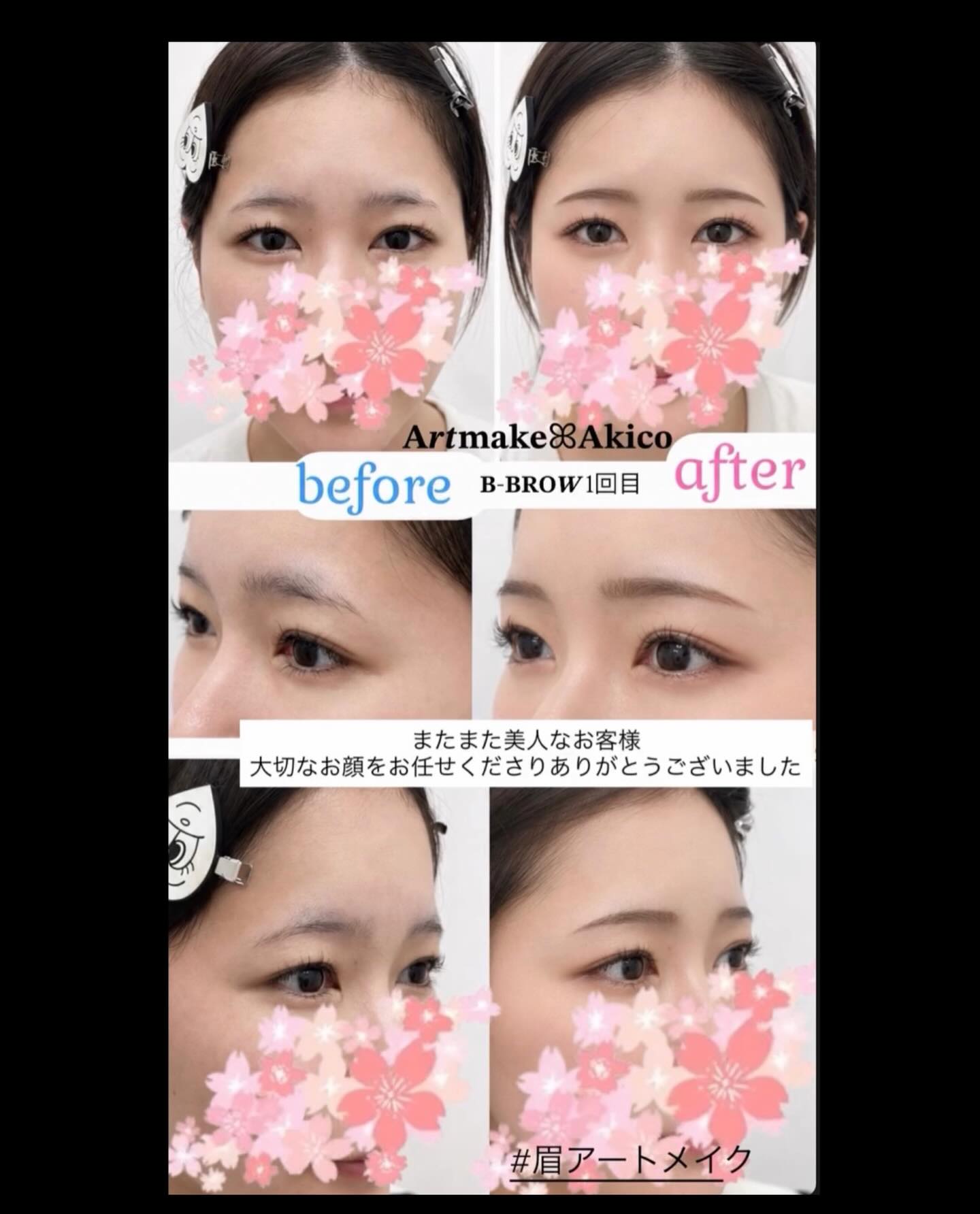 𝐀𝒓𝒕𝐦𝐚𝐤𝐞‎ꕤ︎︎𝐀𝐤𝐢𝐜𝐨‎です
いつもご覧になってくださり
ありがとうございますꕤ︎︎·͜·

お客様が皆さん美人で綺麗な方ばかりで
毎度のことですが、こちらは緊張します

今回もモデルさんのような美人さんがきてくださいましたm(__)m

アレルギー体質の方のアートメイク対応で
ご提供させていただきました🫧

1回目は右眉だけ強く麻酔腫れがあったりと
難航もありましたが、なんとか終えて
土台作りから仕上げていきました

とってもとっても美人なHさん🌸
大切なお顔をお任せくださりありがとうございました♪

　　　　　　
　　　　　　𝐀𝒓𝒕𝐦𝐚𝐤𝐞‎ꕤ︎︎𝐀𝐤𝐢𝐜𝐨‎

#アートメイクモニター募集
#眉アートメイク
#アートメイクキャンペーン 
#アートメイク新宿 
#bbrow
眉毛コンプレックス
眉毛が薄い
眉毛に悩んでいる
眉なし
眉毛薄い
すっぴん眉
左右非対称
眉毛が生えない
アトピー眉毛
すっぴんに自信がない
時短メイク
メイク時短