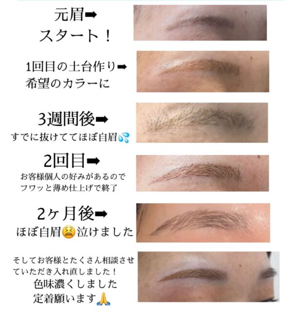 9月になりました🍂🌰
9月もよろしくお願いいたします✨
お久しぶりの投稿ですꕤ︎︎·͜·
イマ、挑戦していることがあって🔥
SNSから少し離れてました😊
いつもご覧になってくださっている方
初めましての方、ありがとうございます😊
𝐀𝒓𝒕𝐦𝐚𝐤𝐞ꕤ︎︎𝐀𝐤𝐢𝐜𝐨です
今日は正直にお伝えします📣‼️
と以前ストーリーにupしたことで
たくさんの方に応援していただいたケースを
ご紹介します🫧
【どーしてこんな早く抜けちゃうの⁉️】
の壁にぶち当たった
とあるモニター様の症例です
こんなこともあるんですね💦
抜けるスピードがジェットコースター級🎢💨
同じように施術させていただいても
こんなに早く抜ける方もいらっしゃいました💦
アートメイクは【最低2回】【必要であれば3回】
施術を繰り返します
定着しない方やターンオーバーが早い方は
中途半端にせずお直しをしていきます✨
2-3ヶ月単位で
アフター連絡しておりますが
抜けるの早すぎる方もいらっしゃると
わかったので、抜けて来たお客様は必ず
1本ご連絡くださいますと幸いです!
【リタッチ必要か】🫧【セルフ対応】か
こちらもお伝えしております😋
眉アートメイクデビューしたての仲間達にも
知ってもらえたら嬉しい✨️
そんなモニター様症例でした❕
こんなことがあったら、そのあとどうするの?
も一緒に考えて、安心したアートメイクをご提供できるアートメイクナースでいたいですね😋
最後までお読みになってくださり
ありがとうございました😊
〰️今日の一言〰️
🦥*̣̩⋆🐌💭🪴🦙
自分らしく生きるって幸せ(*˘︶˘*).。.:*♡
そろそろ推し活戻る準備ꕤ︎︎·͜·