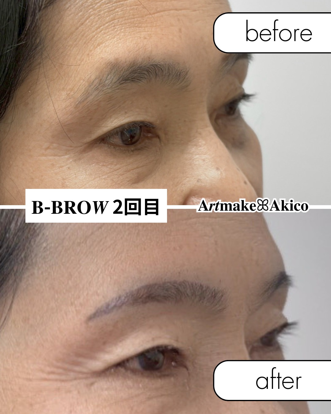 眉アートメイク𝐁-𝐁𝐑𝐎𝑾
モニター様施術事例のご紹介ですꕤ︎︎·͜·
今回は女性(2回目)のモニター様のビフォー・アフター写真です♪
過去のポストで1回目の施術とインタビュー動画も紹介しております。
長年眉毛をうまく描けなく悩まれていたお客様
𝐁-𝐁𝐑𝐎𝑾 2回セットで5歳も10歳も
お若くなりました💞
娘さんに
『お母さん、綺麗になったね、何かしたの?』
と聞かれ、アートメイクをしたとお伝えしたところ
『自然すぎて気づかなかった!綺麗だね』と
おっしゃられていたそうです✨
本当に美しく更にお綺麗になりました🫧
これからは汗をかくジムでも
眉毛気にせず過ごせますね!!
モニター様
大切なお顔をお任せくださりありがとうございました!
1回目は土台作り✨
2回目で完成✨
𝐁-𝐁𝐑𝐎𝑾は直後から自然な仕上がりに
なります♪
🫧オープニングキャンペーン🫧
🫧モニタ-募集のお知らせ🫧
今なら眉毛2回セットが
110,000円→75,000円
と通常価格より35,000円
もお🉐になっています。
それ以外のメニューもお得な料金で施術を受けられます。
✅️アートメイクに興味ある方
✅️B−BROWでアートメイクをしてみたい方
は、より詳しい内容(料金や体験者さまの感想など)をプロフのURLから詳細をチェックしてください。
ぜひぜひお待ちしてます!
また、エリア拡大の準備中です。
新宿・横浜の提携クリニックさんでの施術が可能になります。
準備整い次第、発表致しますので、よろしくお願いします。
また、武蔵野市・吉祥寺・三鷹市エリアで提携してくださるクリニックさんも探しております。
もし目に留まったクリニックの医師・開業医の諸先生方がいらっしゃいましたら、ご挨拶にお伺いさせていただきたいと思います!
小さなことからでも情報を知ってらっしゃる方がおりましたら、重ねてご連絡ください。
よろしくお願いいたします🙇♂️
𝐀𝒓𝒕𝐦𝐚𝐤𝐞ꕤ︎︎𝐀𝐤𝐢𝐜𝐨
#アートメイクモニター募集
#アートメイク
#アートメイク吉祥寺
#アートメイク三鷹
#アートメイク武蔵野市
#眉アートメイク
#bbrow
#眉毛コンプレックス
#眉毛が薄い
#眉毛に悩んでいる
#眉なし
#眉毛薄い
#すっぴん眉
#左右非対称
#眉毛が生えない
#アトピー眉毛
#すっぴんに自信がない
#時短メイク
#メイク時短